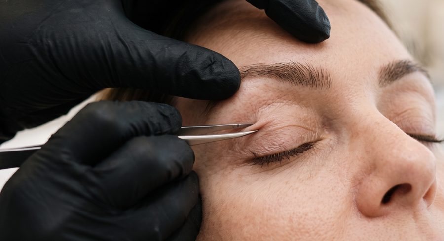 Blefaroplastia Superior